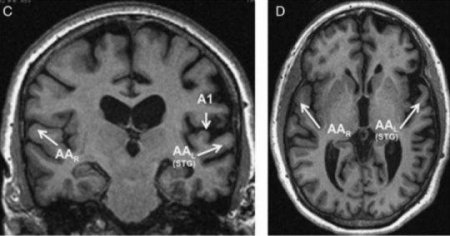 Учёные: Обнаружена избирательная «атака» на участки мозга при болезни Альцгеймера