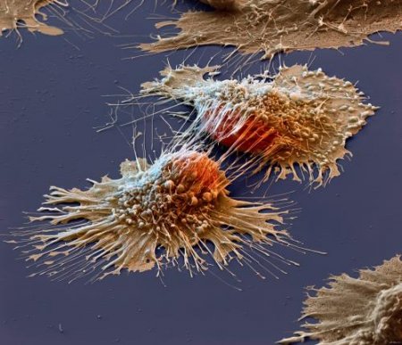 Ученые: Даже самые запущенные формы рака излечимы